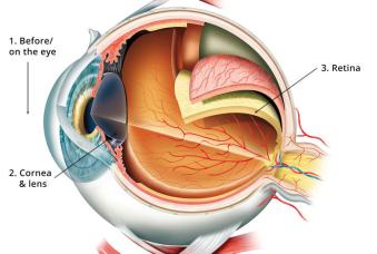 Ophtalmology SwissOptic Ophtalmology SwissOptic